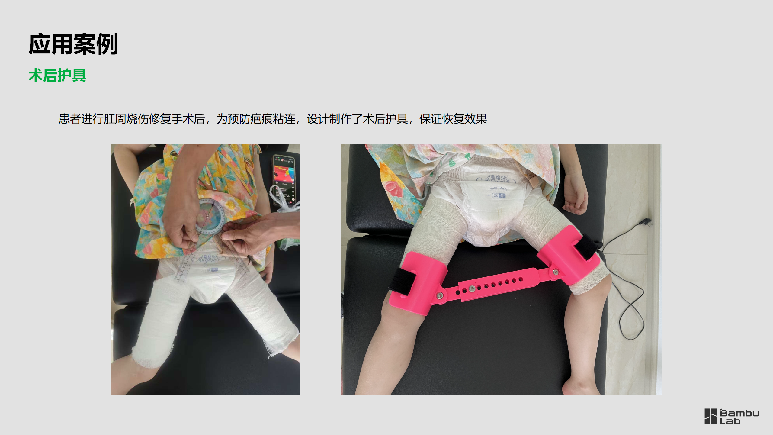 医疗-爱无疆社区康复团队应用案例2025.03.11_06.png